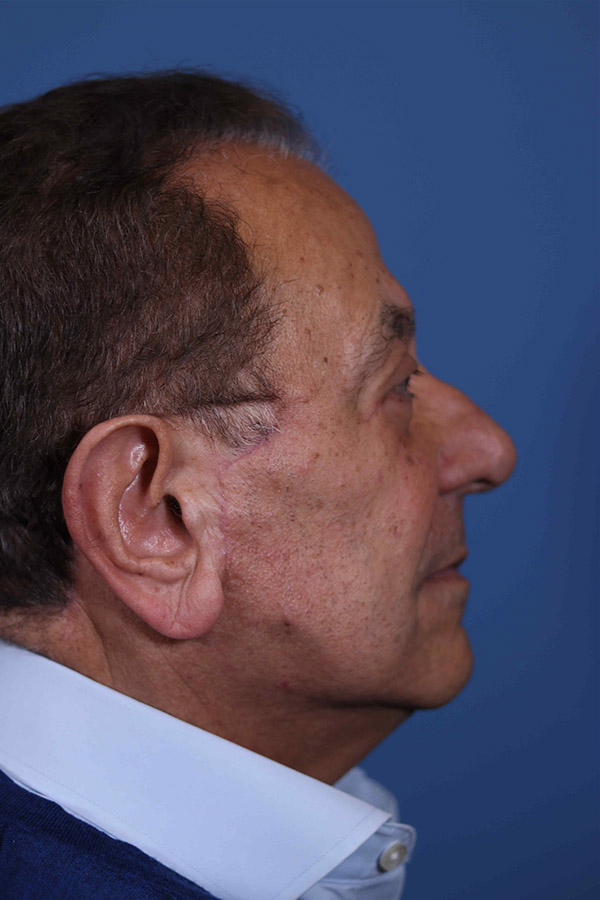 After - Patient 01 - Side View